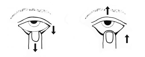 picto prothèse_HOR picto prothèse_HOR